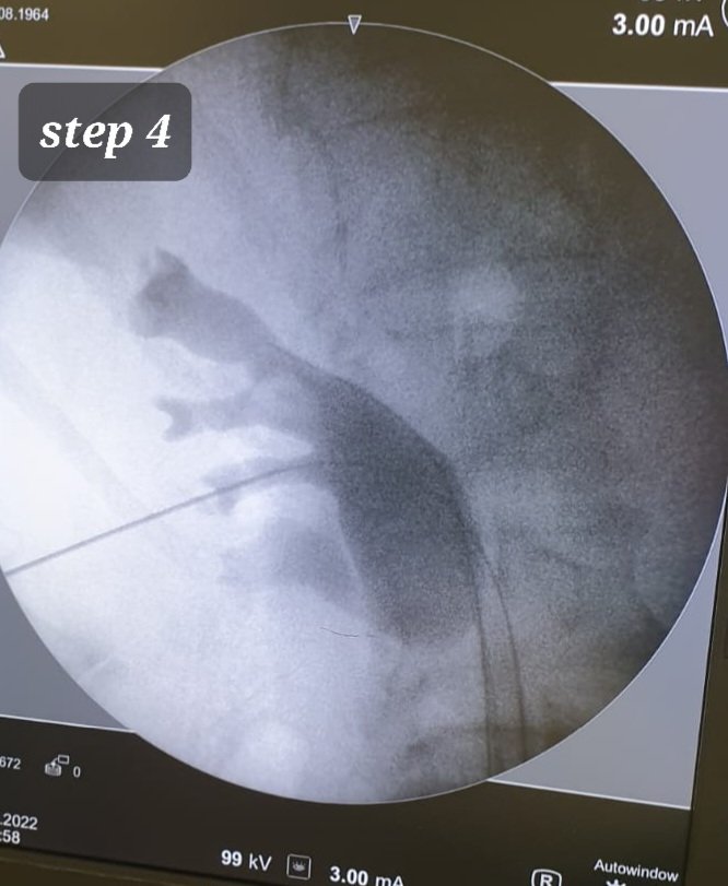 Michele Antonucci (@micheleantonuc3) on Twitter photo US / single plane x-rays #supine #pcnl puncture #stepbystep, easy & fast:
1. US Landmarks drawing (PAL & renal footprint on z-plane)
2. Needle orientation on x/y plane parallel to calyx axis
3. Scratch down to renal footprint
4. Puncture in the center of papilla
<a href="/Endo_Society/">Endourological Society</a> US / single plane x-rays #supine #pcnl puncture #stepbystep, easy & fast:
1. US Landmarks drawing (PAL & renal footprint on z-plane)
2. Needle orientation on x/y plane parallel to calyx axis
3. Scratch down to renal footprint
4. Puncture in the center of papilla
<a href="/Endo_Society/">Endourological Society</a>