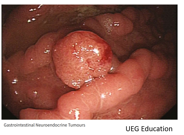 TheAAES's tweet photo. Sometimes, NETs are found incidentally through endoscopic or radiographic procedures done for other purposes.
#NETAM2022 #NeuroendocrineTumor #LetsTalkAboutNETs
@NANETS1 @CarcinoidNETs @LACNETS @PheoPara https://t.co/cYaUhaFNXA