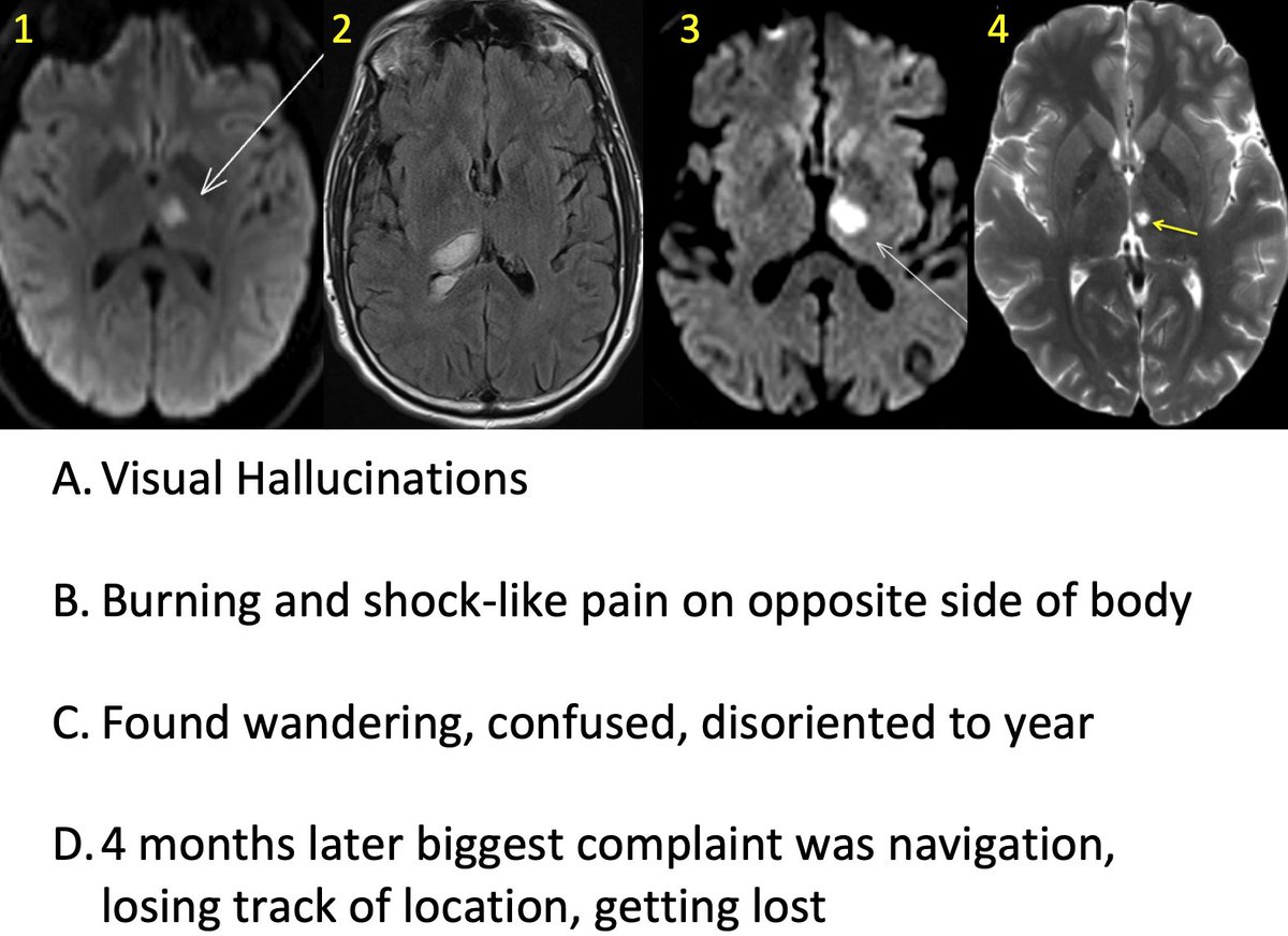 boeslab's tweet photo. We're seeing some interesting thalamic cases thanks to collaborator @kaihwang12's research program.  
See if you can match the lesion with the syndrome... https://t.co/dbYTM0cxrT