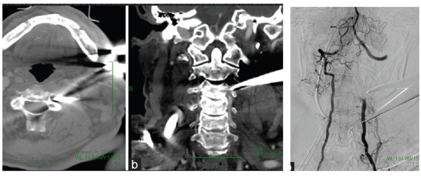 Oren Gottfried, MD on Twitter "Imaging showed a tine(02)