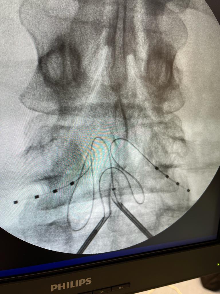 herrero_dr's tweet photo. DRG Stimulation at right C8- left T1 and bilateral L5 at the same in a patient suffering from chronic ischemic pain in hands and feet #bestteam #drgstimulation #neuromodulation #interventionalpainmanagement #chronicpain @MendiolaOsa https://t.co/PiI6KMgtnN