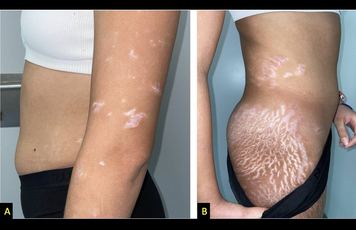 dermaponte's tweet photo. Que pensaríais ante una  👧 12 años que aparece en consulta por ampollas de una semana de evolución localizadas sobre estrías de distensión presentes desde hace meses ? 📚🤔 https://t.co/9NuhIF7X12