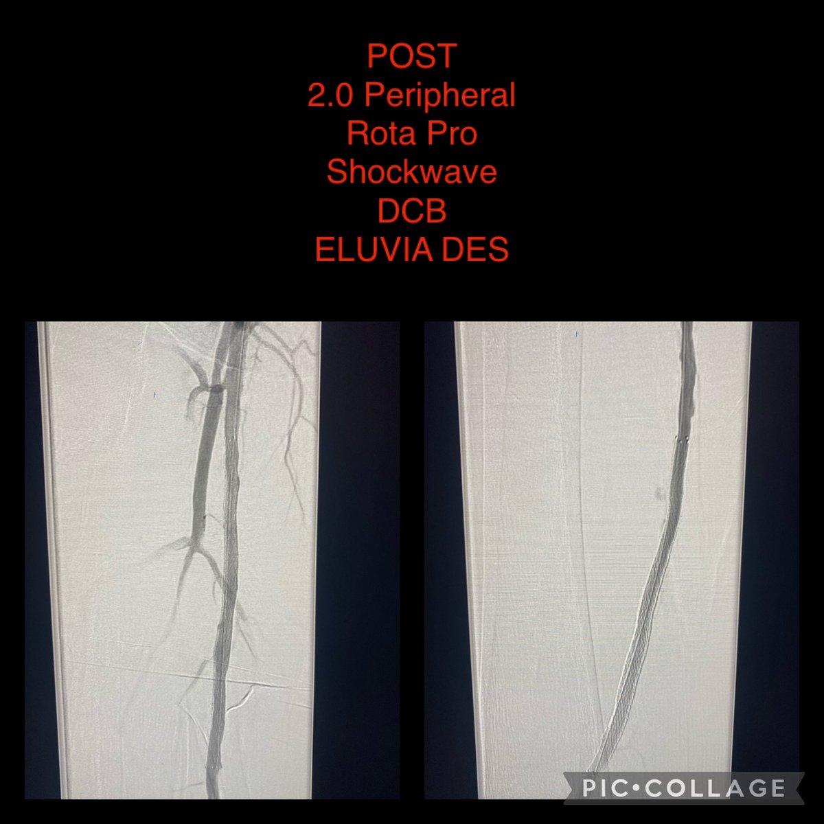 Congratulations to Dr. Boshra Louka, Interventional Cardiologist, at Willis Knighton Heart &amp; Vascular Institute.  Dr. Louka used the first Peripheral Rota Pro in the state of Louisiana!