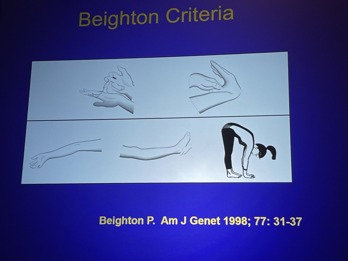 Rebecca Erwin Wells, MD, MPH, FAHS, FAAN (@rebeccawellsmd) on Twitter photo Do you check the Beighton score in your patients with #migraine to assess for hyper mobility? If not, maybe we should, suggests <a href="/NHF/">National Headache Foundation (NHF)</a> President Dr Vincent Martin <a href="/ahsheadache/">American Headache Society</a> #AHSAZ2022 Do you check the Beighton score in your patients with #migraine to assess for hyper mobility? If not, maybe we should, suggests <a href="/NHF/">National Headache Foundation (NHF)</a> President Dr Vincent Martin <a href="/ahsheadache/">American Headache Society</a> #AHSAZ2022