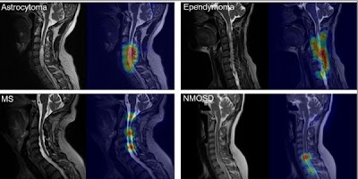 Radiology_AI's tweet photo. Automated Classification of Intramedullary Spinal Cord Tumors and Inflammatory Demyelinating Lesions Using Deep Learning https://t.co/Cy4KxWL9lX @TJMU_China @unige_en @Health_Eng #NeuroRad #demyelination #ML #FSS22 https://t.co/YxxtmKmkHP