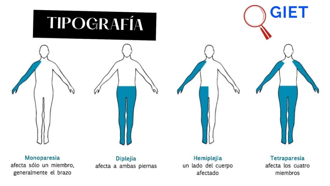 GIET2_0's tweet photo. ℹ️Info! El día de hoy te presentamos información sobre la PARÁLISIS CEREBRAL. https://t.co/Je1nDncGrU