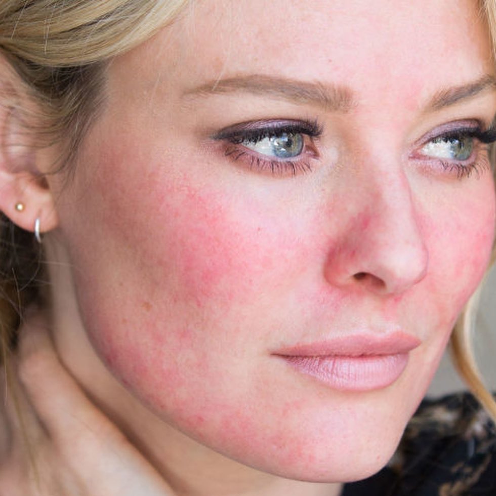 dani_dials's tweet image. Spicy foods, alcohol and sipping hot beverages also trigger rosacea flares. #tipoftheday