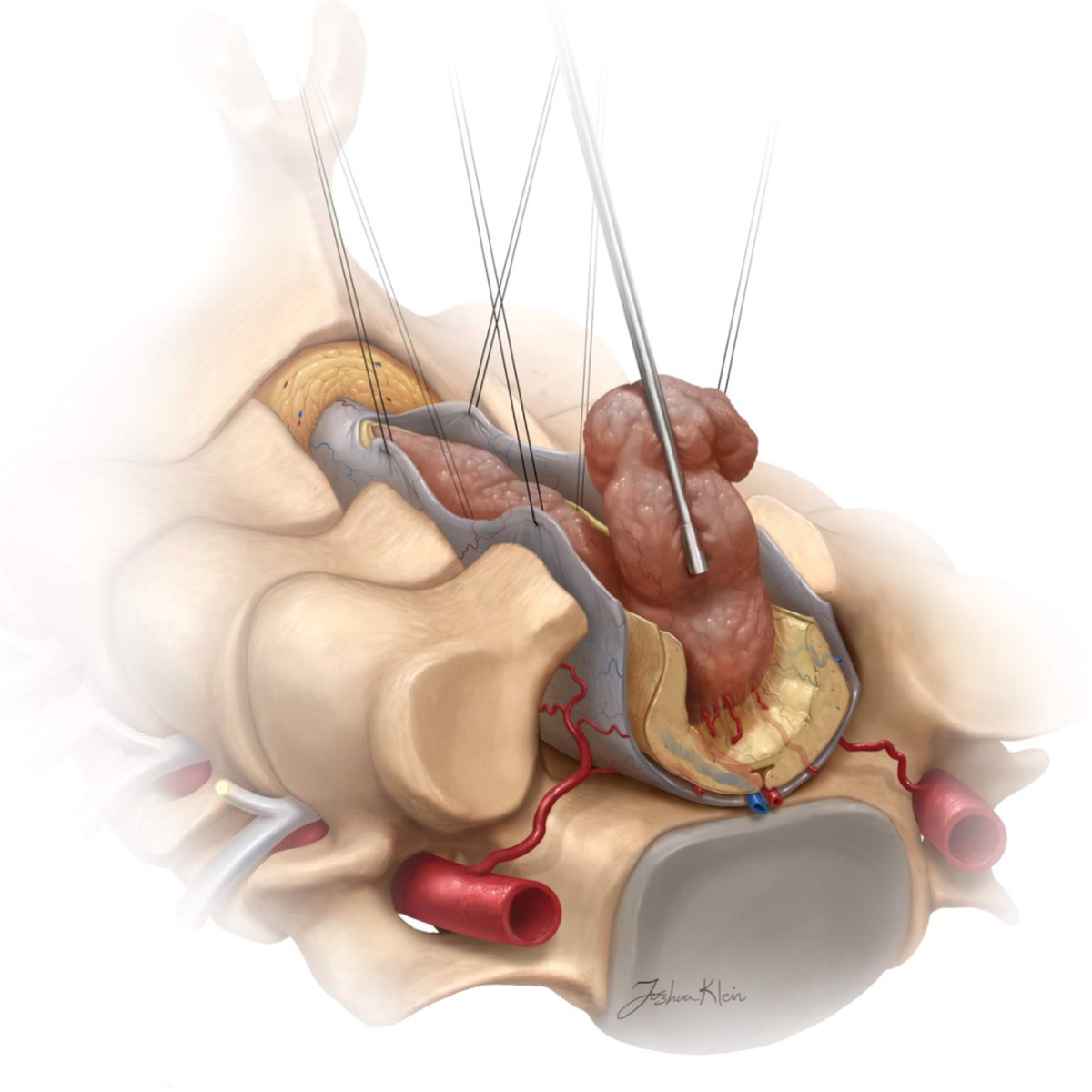 neurosurgatlas's tweet photo. The most common intramedually spinal cord tumors are ependymomas, astrocytomas, and hemangioblastomas. In order of importance: preservation of function, tumor debulking, and gross total resection are the goals of surgery for these challenging entities.

#MedTwitter #Neurosurgery https://t.co/MljAVwNZJn
