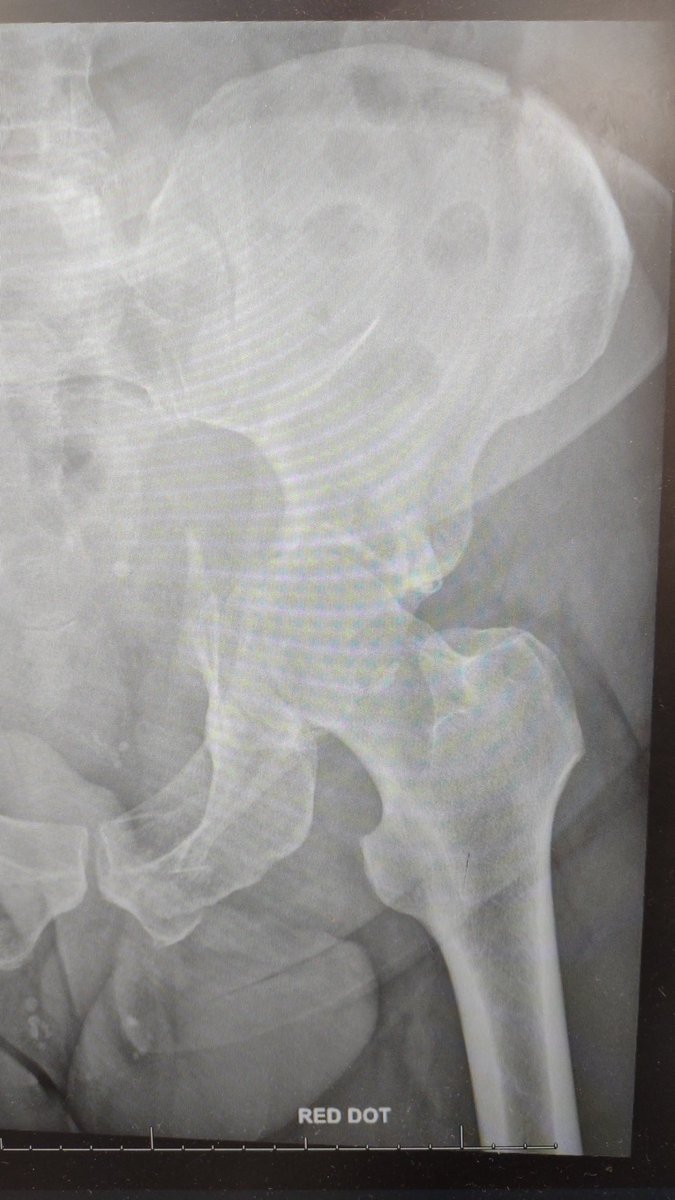 72 year old man, hobbled into the emergency room complaining of left hip pain. What is the diagnosis?

#EmergencyMedicine #emergency #doctor #nurse #MedStudentTwitter