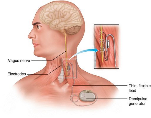 Стимулятор блуждающего нерва. VNS стимулятор. Vagus nerve stimulation аппарат. Вагус лицо. Стимуляция блуждающего нерва.