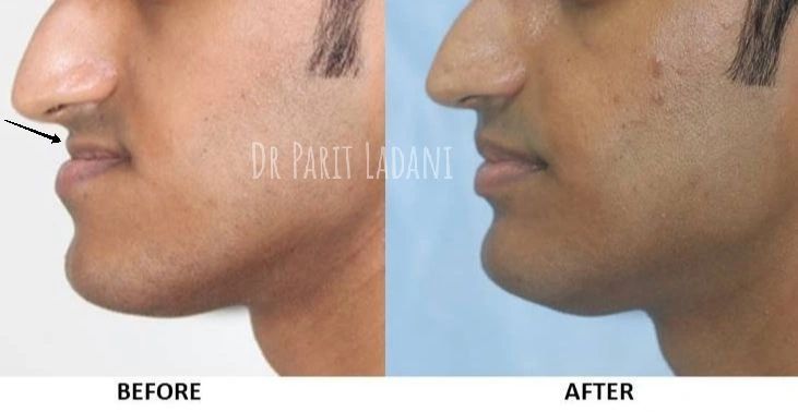𝗪𝗵𝗮𝘁 𝗶𝘀  𝗝𝗮𝘄 𝗦𝘂𝗿𝗴𝗲𝗿𝘆 𝗖𝗼𝘀𝘁 𝗶𝗻 𝗠𝘂𝗺𝗯𝗮𝗶 ?

click here to know👇
cleftsurgerymumbai.in/corrective-jaw…

{For appointment : +91 9867472415}

#jawsurgery #orthognathicsurgery #correctivejawsurgery #bijawsurgery #jawsurgerymumbai #maxillaryadvancement #jawsurgeonmumbai