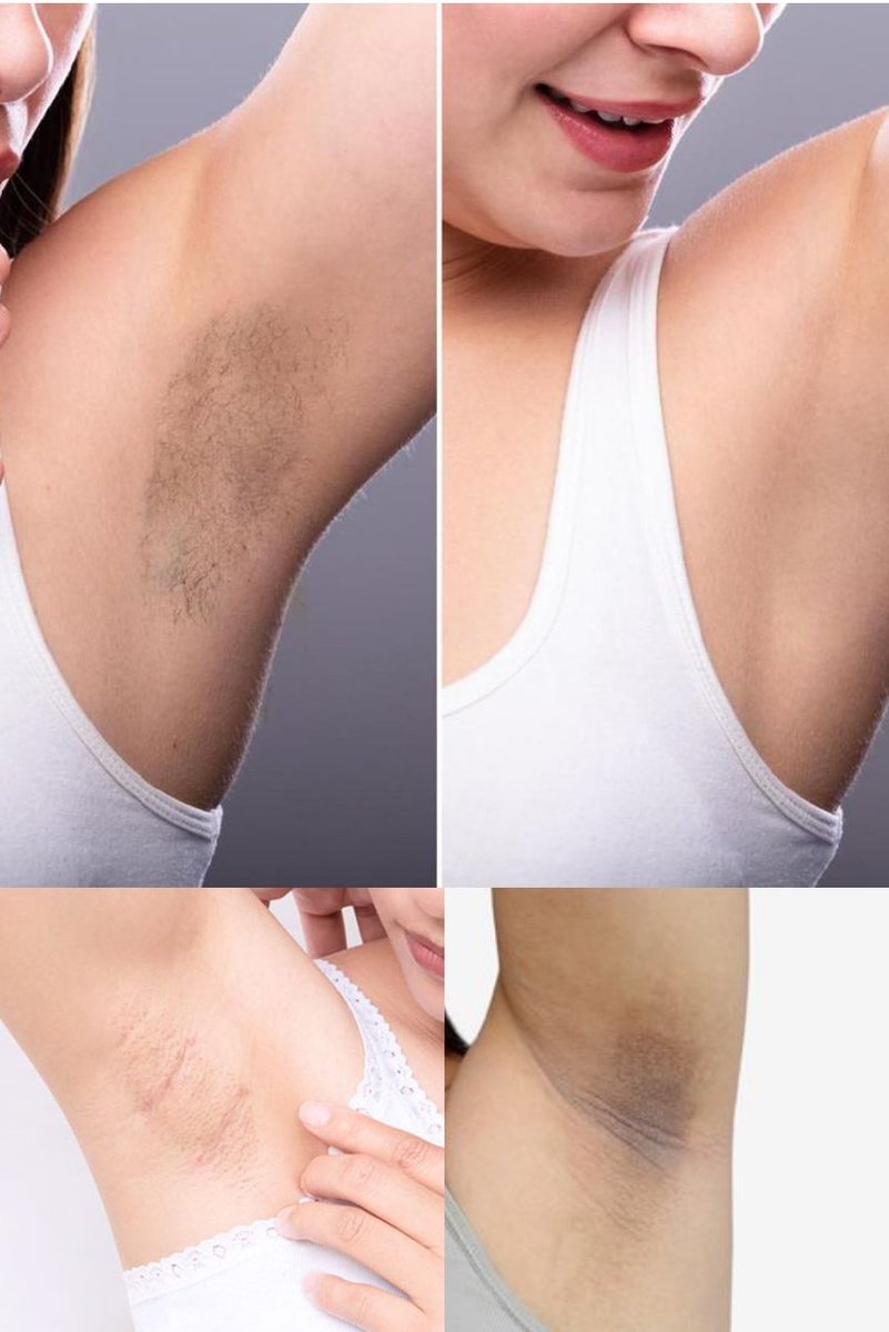 ✨ CARA MENCERAHKAN KETIAK BY ME✨

Yang pengin punya ketiak cerah dan bersih wajib banget buat mampir!!!
Punya kulit ketiak yg cerah, bersih gk chicken skin itu idaman banget gak sih?
Kalo msh bingung mau mulai dri mana buat merawat ketiak yuk simak tips dri aku 

A Thread 👇