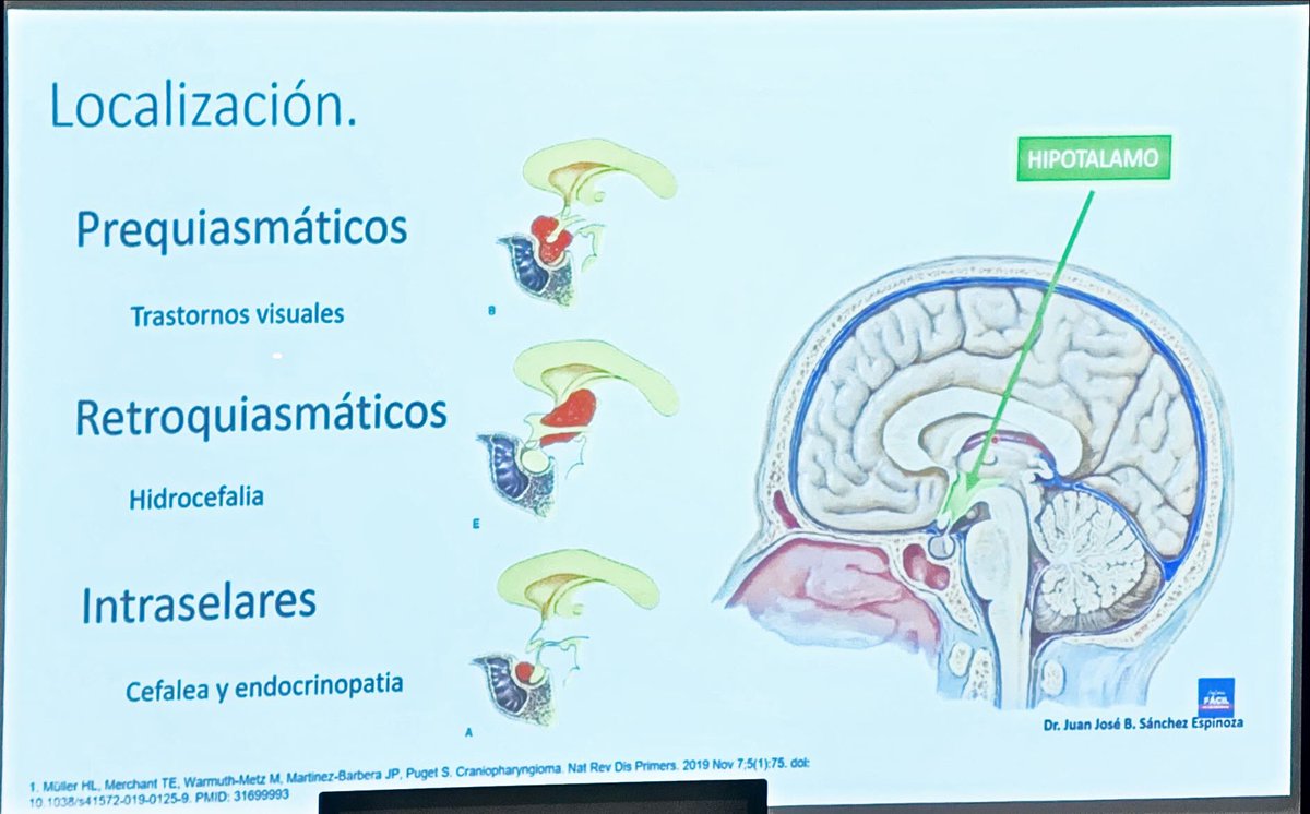 ElenaDF75's tweet photo. Comorbilidades en #craneofaringioma intervenido 
@AvilesMariola 

Localización: prequiasmatico, retroquiasmático o intraselares 

La cirugía es la primera opción: importante equipo multidisciplinar 
@SAEDYN_ https://t.co/pPwyoCryRi