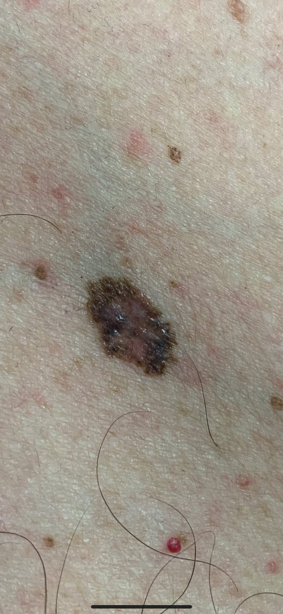 mig_yec's tweet photo. ¿Qué tienen en común estas 3 lesiones? ¿Podrías llegar al diagnóstico?
—
What do these 3 injuries have in common? Could you get to the diagnosis?
🤓🕵🏼‍♀️🕵🏽
#CaseChallenge #Dermtwitter https://t.co/LoffAitnLs