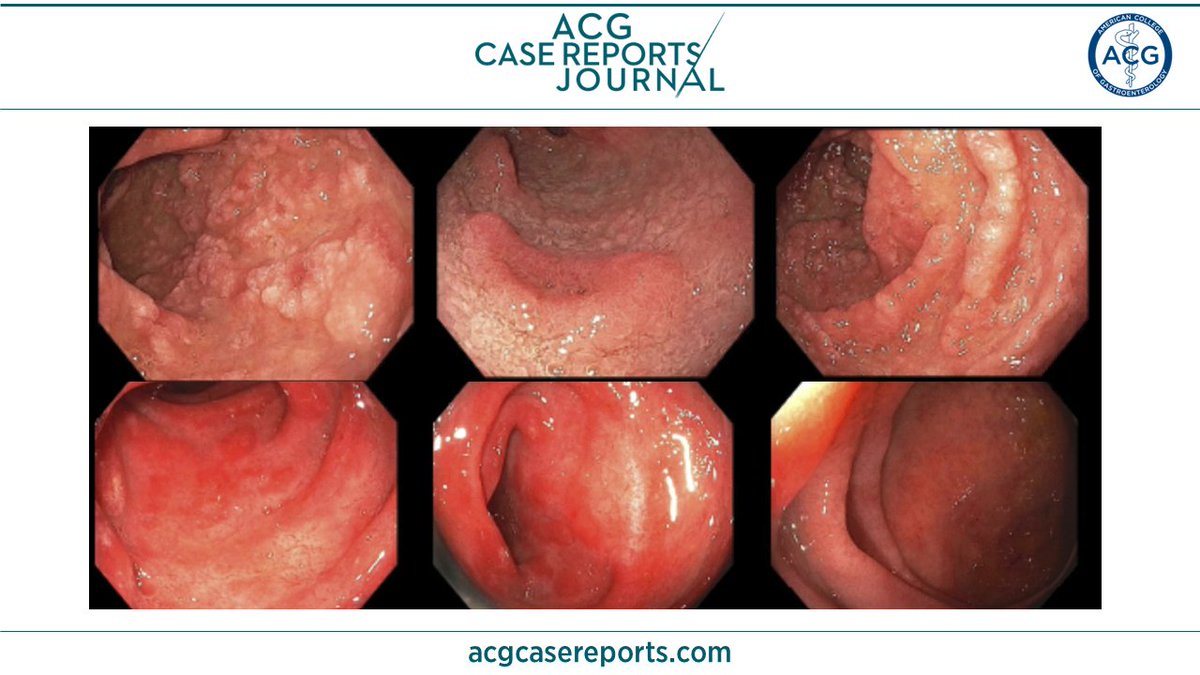 🔎 ACG Case Reports Journal 🔍 Open-Capsule Budesonide for the Treatment of Isolated Immune Checkpoint Inhibitor-Induced Enteritis Hussain, et al. 👉 bit.ly/3AuJ3G6 #GItwitter #GIfellows @NickMcDonaldMD @SempokuyaMD @NadeenHussainMD @Badr_AlBawardy