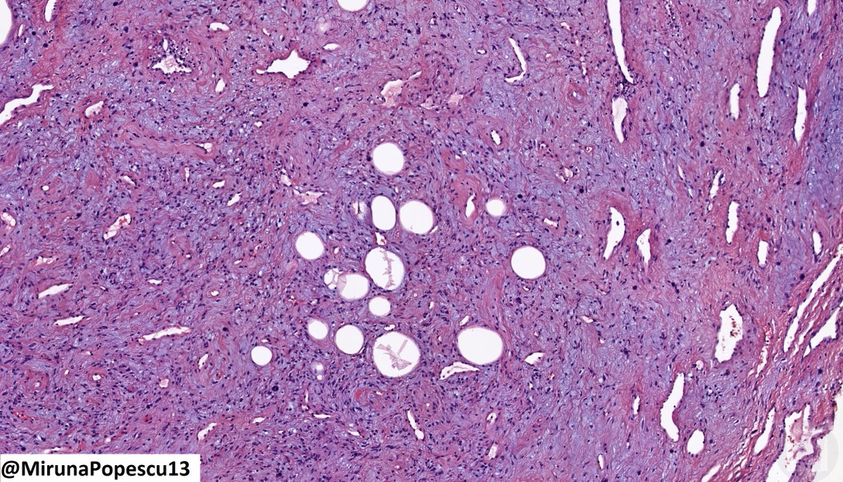 55 y/o M with a shoulder mass. What is your diagnosis? 🔍
WSI digital slide 🔬: kikoxp.com/posts/17742
Answer, summary info & MCQs 📚: kikoxp.com/posts/17738

#PathTwitter #BSTPath #pathresidents #pathfellows