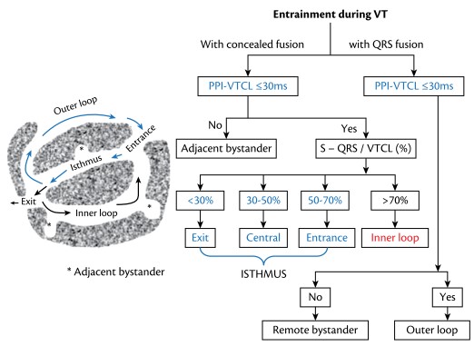 Yuksek Ihtisas Arrhythmia- Ankara City Hospital (@ach_epteam) on Twitter photo Dual exit or intermittent capture or ?
<a href="/MeltemAltnsoy/">ScarelatedVT</a> <a href="/gozgeyun/">g.özge mert</a> <a href="/Drersoy84/">İbrahim Ersoy</a> <a href="/Drmuammerkardio/">Muammer Karakayalı</a> <a href="/aliugursoysal/">Ali Uğur Soysal</a> <a href="/drgarez/">Murat Kerkutluoglu</a> <a href="/drsihohidayet/">ŞIHO HİDAYET</a> <a href="/simsekersinc/">Ersin Çağrı Şimşek</a> <a href="/GokhanCeyhun1/">Gokhan Ceyhun</a> <a href="/Mkara_EP/">Mkara</a> <a href="/ElifhandeMD/">Elif Hande Özcan Çetin</a> <a href="/AhmetKorkmaz07A/">Ahmet</a> <a href="/prof_serkan_cay/">Prof Dr Serkan Cay</a> <a href="/DursunAras2/">Dursun Aras, Professor</a> <a href="/topaloglu_prof/">Serkan Topaloglu, MD</a>
<a href="/DrRoderickTung/">Roderick Tung</a> #Epeeps Dual exit or intermittent capture or ?
<a href="/MeltemAltnsoy/">ScarelatedVT</a> <a href="/gozgeyun/">g.özge mert</a> <a href="/Drersoy84/">İbrahim Ersoy</a> <a href="/Drmuammerkardio/">Muammer Karakayalı</a> <a href="/aliugursoysal/">Ali Uğur Soysal</a> <a href="/drgarez/">Murat Kerkutluoglu</a> <a href="/drsihohidayet/">ŞIHO HİDAYET</a> <a href="/simsekersinc/">Ersin Çağrı Şimşek</a> <a href="/GokhanCeyhun1/">Gokhan Ceyhun</a> <a href="/Mkara_EP/">Mkara</a> <a href="/ElifhandeMD/">Elif Hande Özcan Çetin</a> <a href="/AhmetKorkmaz07A/">Ahmet</a> <a href="/prof_serkan_cay/">Prof Dr Serkan Cay</a> <a href="/DursunAras2/">Dursun Aras, Professor</a> <a href="/topaloglu_prof/">Serkan Topaloglu, MD</a>
<a href="/DrRoderickTung/">Roderick Tung</a> #Epeeps