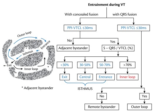 Dual exit or intermittent capture or ? @MeltemAltnsoy @gozgeyun @Drersoy84 @Drmuammerkardio @aliugursoysal @drgarez @drsihohidayet @simsekersinc @GokhanCeyhun1 @Mkara_EP @ElifhandeMD @AhmetKorkmaz07A @prof_serkan_cay @DursunAras2 @topaloglu_prof @DrRoderickTung #Epeeps