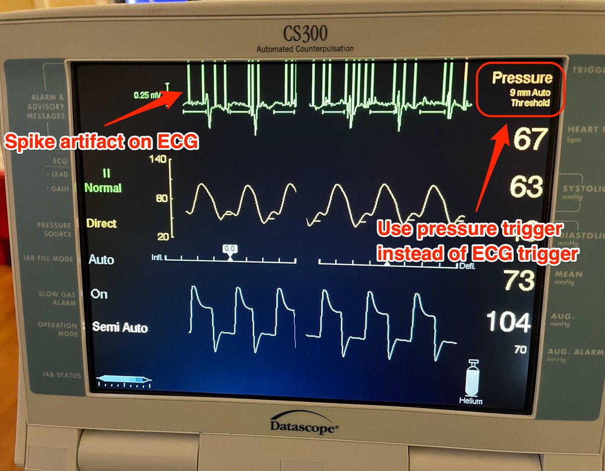 Icu Stapping Pattern Here’s a fun ICU puzzle: what is causing this crazy spiking pattern on ...