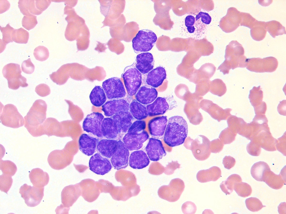 hemepathguy's tweet photo. End stage carcinoma. Peripheral blood. Carcinocythemia. https://t.co/SAOn91hra0