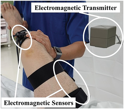 aossmjournals's tweet image. Concomitant injury to #Kaplanfibers of the #iliotibialband did not significantly affect the #pivotshift phenomenon quantified using an electromagnetic measurement system in acute ACL injury  @kantona09 
@yuichi_hoshino 
@J_YAMASAKI 
  ow.ly/jB0N50L8v2O
