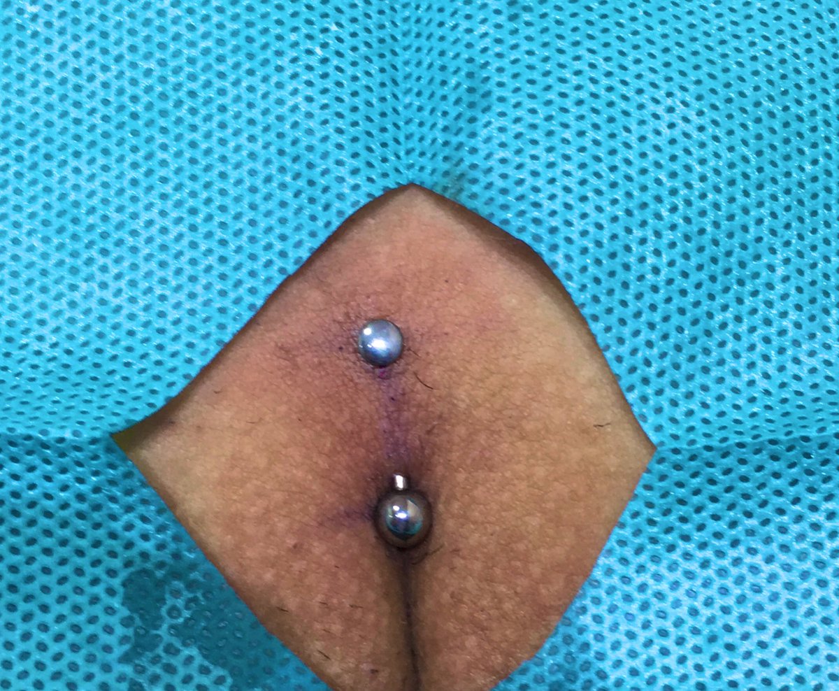 Perfuração íntima 
Chistina piercing. Joia em titânio grau implante. 

#piercing #piercer #bodypiercer #bodypiercing #cartilage #cartilagepiercing #cartilagem #cartilagempiercing  #modificacaocorporal #safepiercing #piercingseguro #adorno #bodyart #bodyartpiercing  #safepiercing