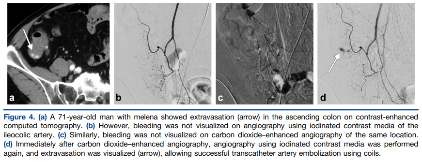Carbon Dioxide Angiography for the Detection of Lower Gastrointestinal Arterial Bleeding Initially Occult to Angiography with Iodinated Contrast Media
Y. Sawada,MD, M. Shimohira,MD, K. Nagai,MD, T. Kawai,MD, K. Ohta,MD, K. Nakayama,MD, and Y. Shibamoto,MD

ow.ly/ia0B50LHiOJ