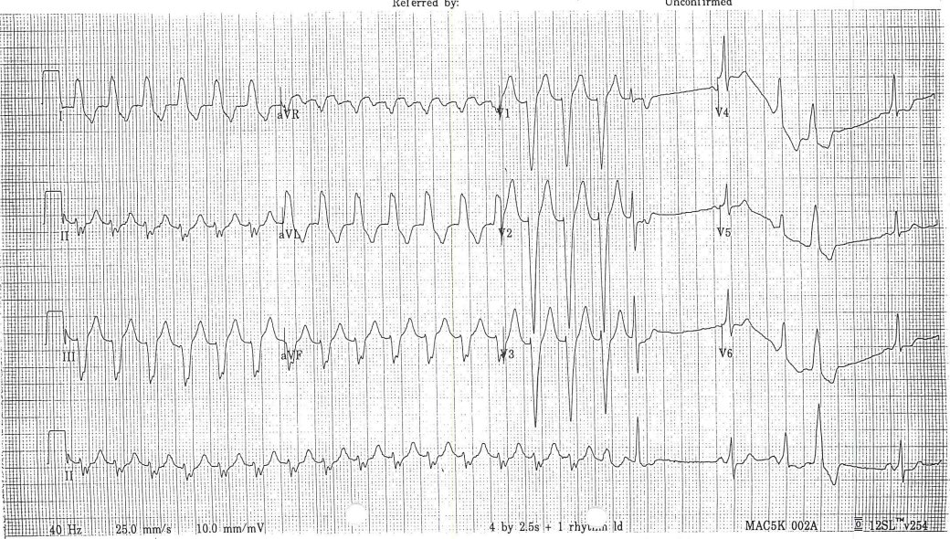 #EPfellows #Cardiologyfellows What is the mechanism of this tachycardia? How is it terminated? <a href="/EPeeps_Bot/">EP_Bot</a>