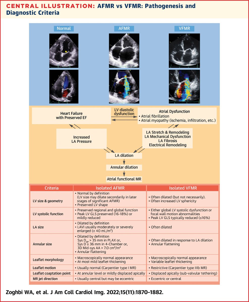 📢📢📢Atrial Functional #mitralregurgitation definition: 
👉Normal LV size and systolic function (no papillary muscle displacement) 
👉Both mitral annular dilation and LA enlargement
👉Loss of normal MV systolic leaflet concavity toward the LV
jacc.org/doi/10.1016/j.…
#Echofirst