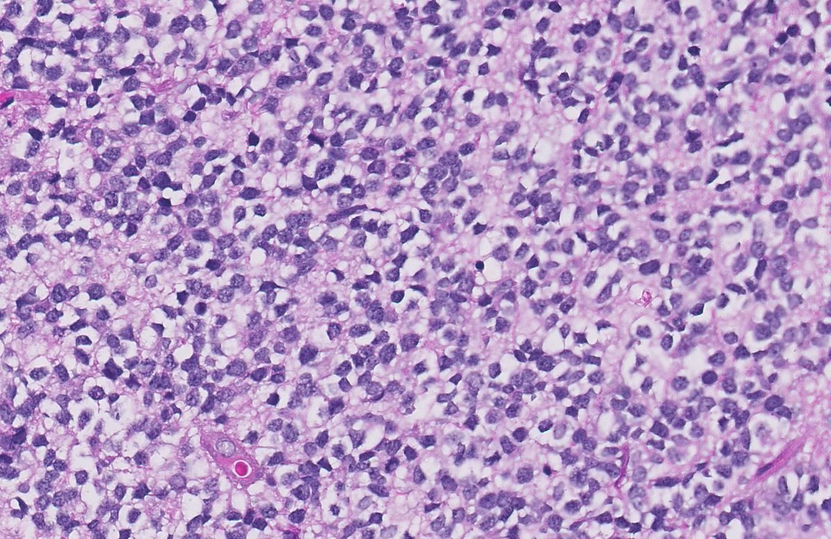 FelipePatologia's tweet photo. 3yo girl with a brain mass.

IHC and quiz in the thread.

What is your diagnosis?

#pathtwitter #neuropath #neurotwitter 

@RawiaMo57385655 @GeronimoJrLapac https://t.co/MzOzub2pdL