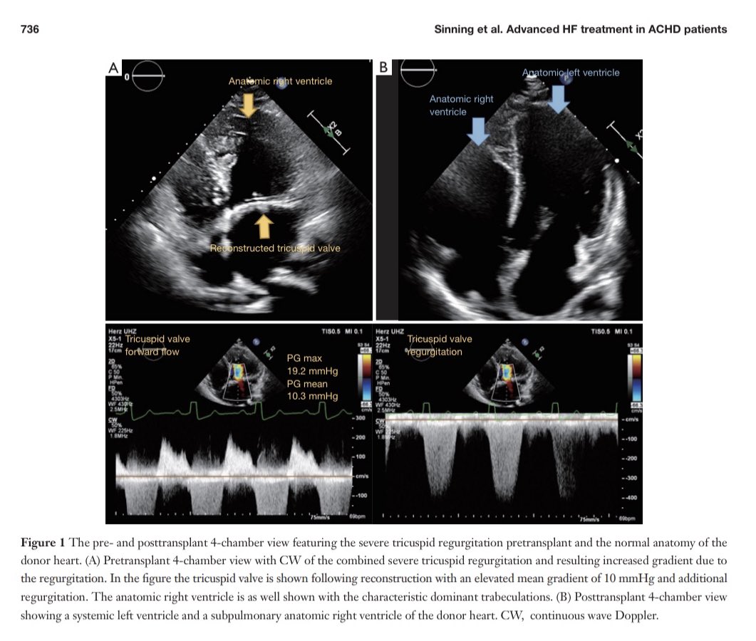 Serginho1409's tweet image. Treatment of advanced heart failure in adults with congenital heart 
disease: a narrative review and clinical cases. dx.doi.org/10.21037/cdt-2… #HeartFailure #CardioEd #CardioTwitter