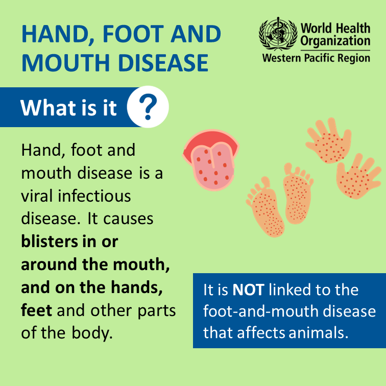 Hfmd Hand Foot Mouth Disease Hand Foot And Mouth Disease Mouth My XXX