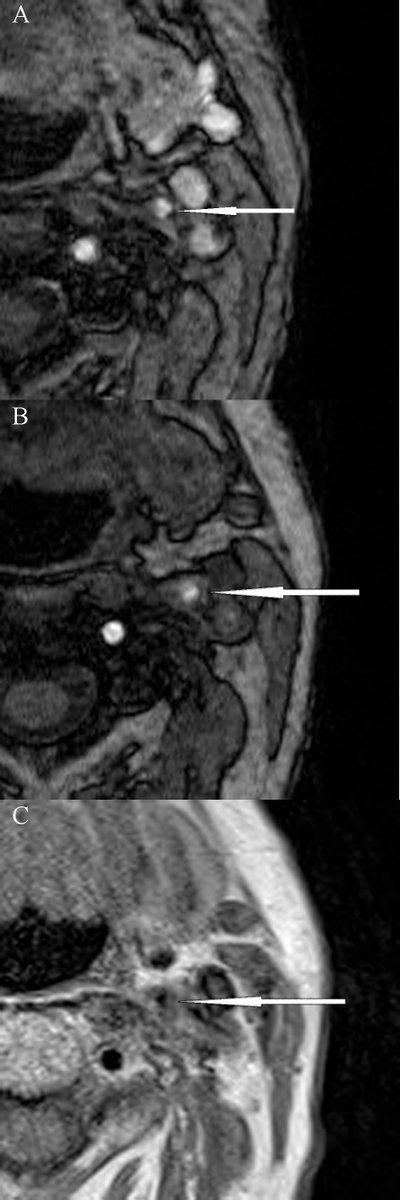 RCMjournal's tweet photo. #RCM - Vol. 22 No. 4
#Callforread
⌛️The role of magnetic resonance imaging and the expression of MMP-9 protein in the analysis of carotid atherosclerotic plaques in patients undergoing carotid endarterectomy: a prospective pilot study
@DavorinSef
#MRI
https://t.co/cmGhS0drVE https://t.co/tsKvnZJBxS