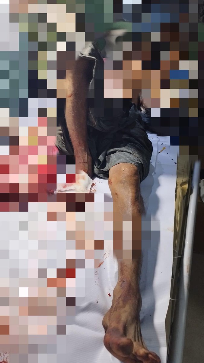 spring_2021's tweet photo. TW// Blood

At around 8pm on Nov7,Military Council Troops recklessly opened artillery shells to ShaneMaKar Village,Wetlet Tsp,Sagaing— 3 locals including an old woman and a child were injured and a woman was killed.

#2022Nov8Coup 
#CrimesAgainstHumanity 
#WhatsHappeningInMyanmar https://t.co/iRZJGVCanP