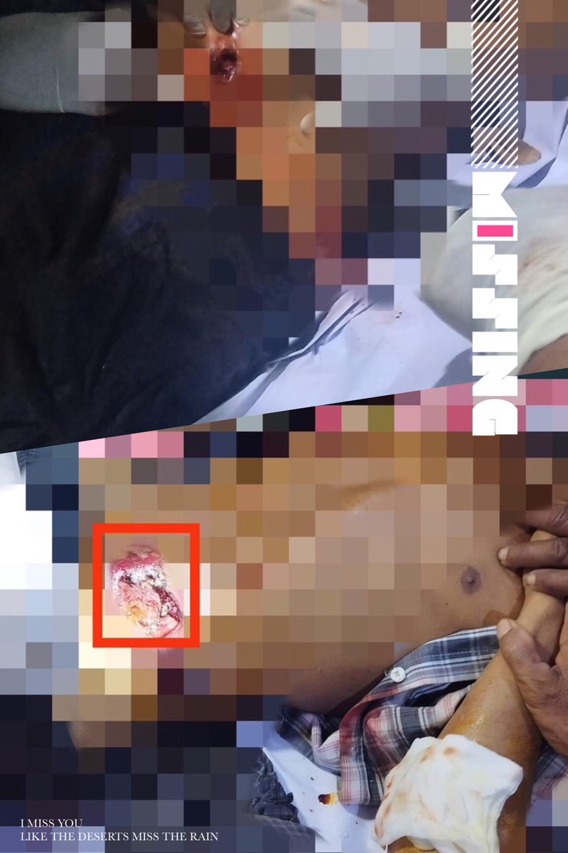 spring_2021's tweet photo. TW// Blood

At around 8pm on Nov7,Military Council Troops recklessly opened artillery shells to ShaneMaKar Village,Wetlet Tsp,Sagaing— 3 locals including an old woman and a child were injured and a woman was killed.

#2022Nov8Coup 
#CrimesAgainstHumanity 
#WhatsHappeningInMyanmar https://t.co/iRZJGVCanP