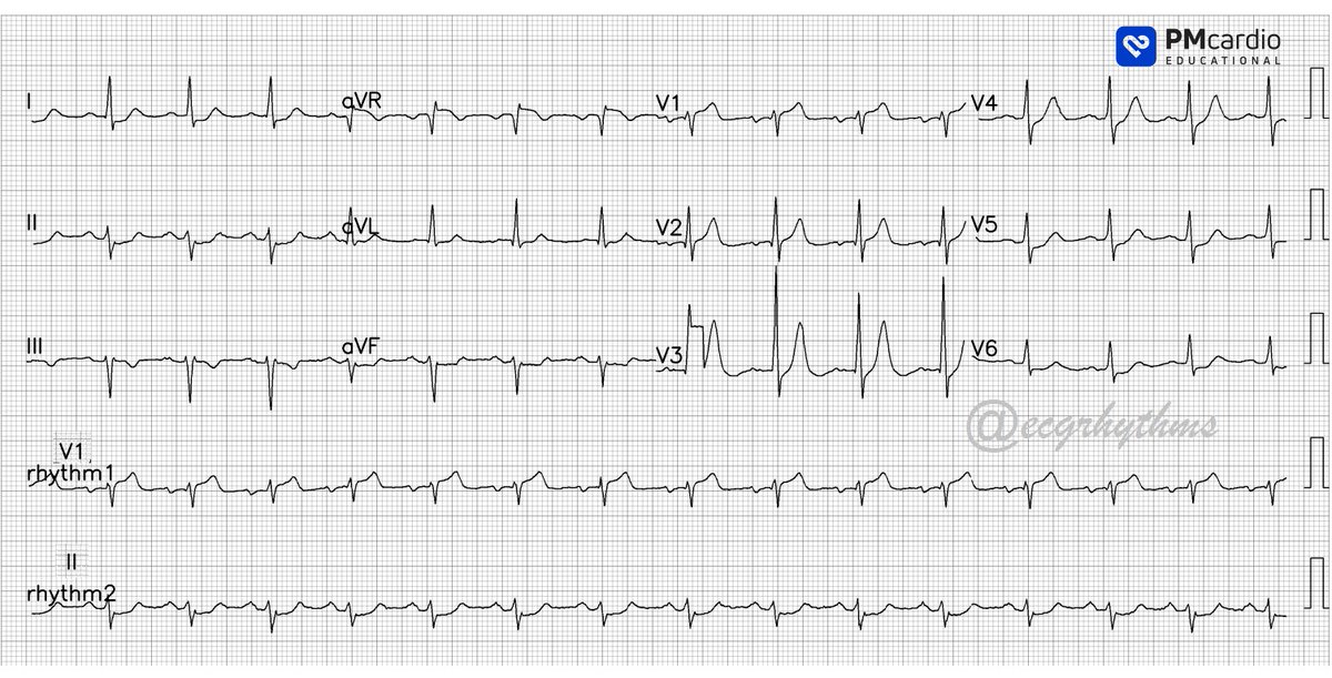 Arnel Carmona (@ecgrhythms) on Twitter photo From the archives/sent by a friend series
Digitized using #PMCardia
60yo DM HTN c/o CP. What is the ECG interpretation? Poll next
#FOAMed
#Meded
#CardioTwitter
#EPeeps
#ECG
<a href="/EcgOxford/">🫀EcgOxford</a> <a href="/ECGEPSCADEVICE/">色々自粛中(ガラス細工の様な繊細なハートを持つ貴公子🤴)サブ垢です🙇♂️</a> <a href="/EM_RESUS/">Sam Ghali, M.D.</a> <a href="/RobertHermanMD/">Robert Herman, MD</a> <a href="/DJAPRN/">Douglas Abraham, FNP-C, ENP-C.</a> <a href="/clinica_sec/">Asociación Cardiología Clínica SEC</a> <a href="/ECGPT2/">ぺいぺい</a> <a href="/smithECGBlog/">Stephen W. Smith</a> From the archives/sent by a friend series
Digitized using #PMCardia
60yo DM HTN c/o CP. What is the ECG interpretation? Poll next
#FOAMed
#Meded
#CardioTwitter
#EPeeps
#ECG
<a href="/EcgOxford/">🫀EcgOxford</a> <a href="/ECGEPSCADEVICE/">色々自粛中(ガラス細工の様な繊細なハートを持つ貴公子🤴)サブ垢です🙇♂️</a> <a href="/EM_RESUS/">Sam Ghali, M.D.</a> <a href="/RobertHermanMD/">Robert Herman, MD</a> <a href="/DJAPRN/">Douglas Abraham, FNP-C, ENP-C.</a> <a href="/clinica_sec/">Asociación Cardiología Clínica SEC</a> <a href="/ECGPT2/">ぺいぺい</a> <a href="/smithECGBlog/">Stephen W. Smith</a>