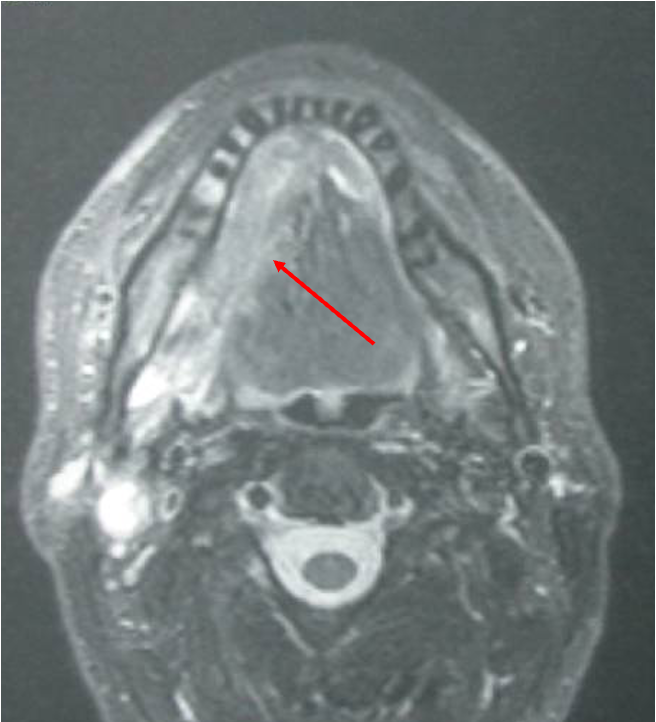 November is Mouth Cancer Action Month

While not one of the commonest cancers, it can be deadly if not caught early

A non healing ulcer for more than 3 weeks or persistent white or red patch ? Most will not be cancer but please get checked urgently

Here is a late presentation