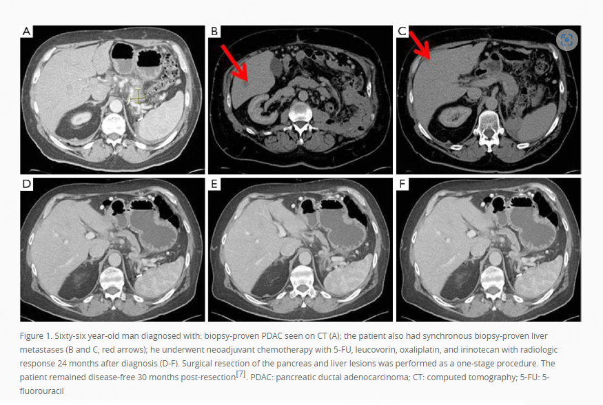 OAE_JCMT's tweet photo. Happy to share the interesting publication👇
''Is there a role for resection of oligometastatic disease in pancreatic ductal adenocarcinoma? ''
#OpenAccess #pancreatic #pancreatic #ductal #adenocarcinoma
🧐download:https://t.co/bvmzBD5Qh6 https://t.co/IqAtXuxE4S