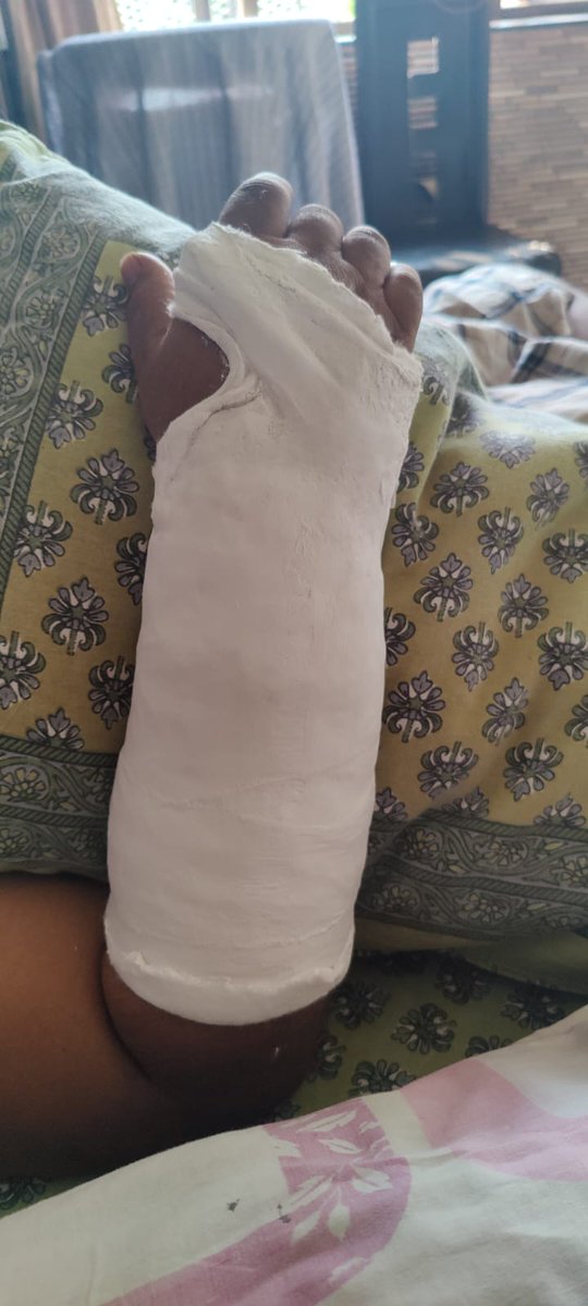 gupptaaaaa's tweet photo. @IndiGo6E is a class apart at providing cheap services and cheap tactics that led to a disloaction &amp; fracture in my dad's arm for a mistake of their own. The incident occurred at Bareilly airport on flight 919 - 7th Nov during the boarding of the flight. we had 5 people traveling https://t.co/U8MJOhGwmf