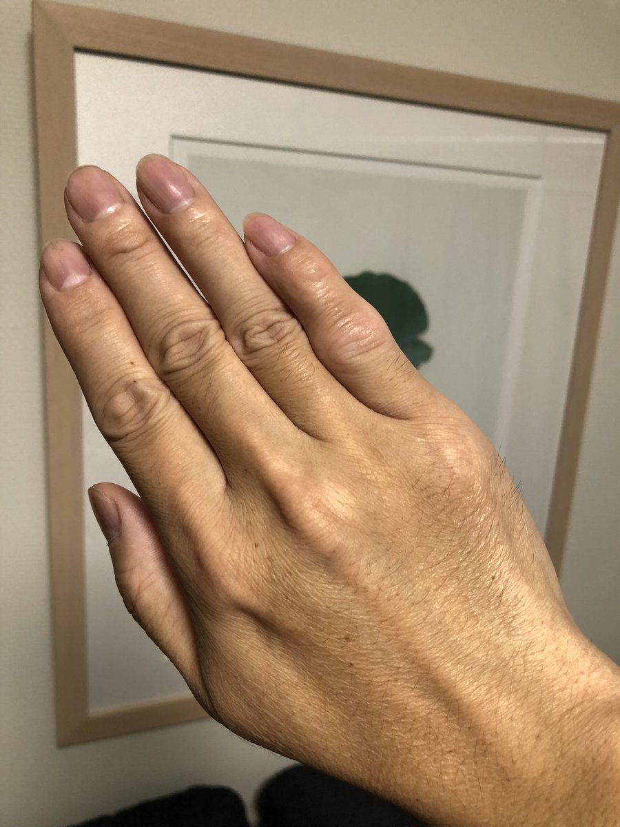 6月から始まった小指第二関節のリハビリが今日で終了しました。 全く
