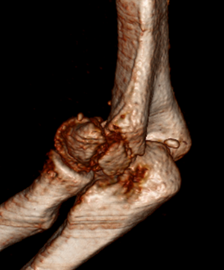 Hellbow of the week, and its only tuesday. Fair to say I underestimated this one a bit. Plain films dont look that scary - CT gets more interesting. Trochlea and Capitellum split in all 3 axis. radial column mush, dorsal trochlea very iffy #orthotwitter