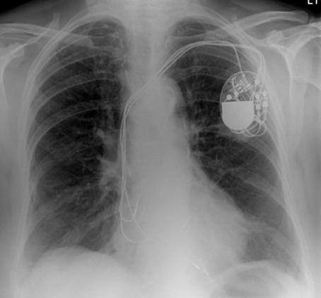 What is the artifact?
What else is there to see? Look very carefully!
radiologymasterclass.co.uk/gallery/chest/…