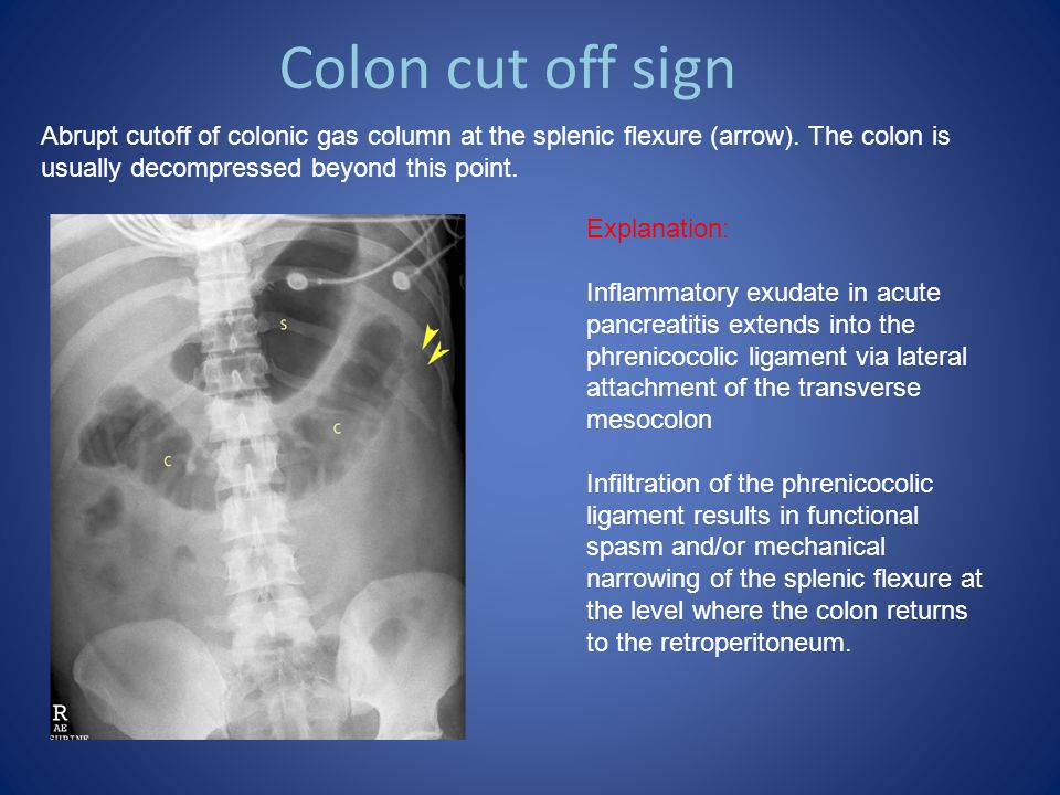 Colon Cutoff Sign