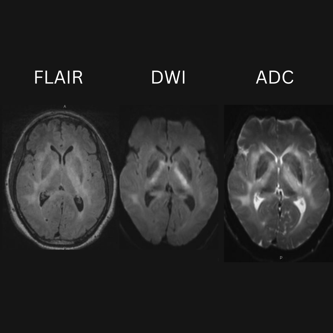 NeuroimagingN's tweet photo. Gliomatosis cerebri
·
Biopsy proven

#gliomatosiscerebri #neurooncology #neurology #neuroinflammation #neuroimaging #neurology #neuroradiology #oncology #neurosurgery #neurotwitter https://t.co/AYR26Fqxw4