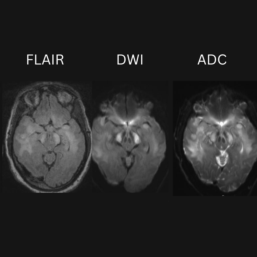 NeuroimagingN's tweet photo. Gliomatosis cerebri
·
Biopsy proven

#gliomatosiscerebri #neurooncology #neurology #neuroinflammation #neuroimaging #neurology #neuroradiology #oncology #neurosurgery #neurotwitter https://t.co/AYR26Fqxw4