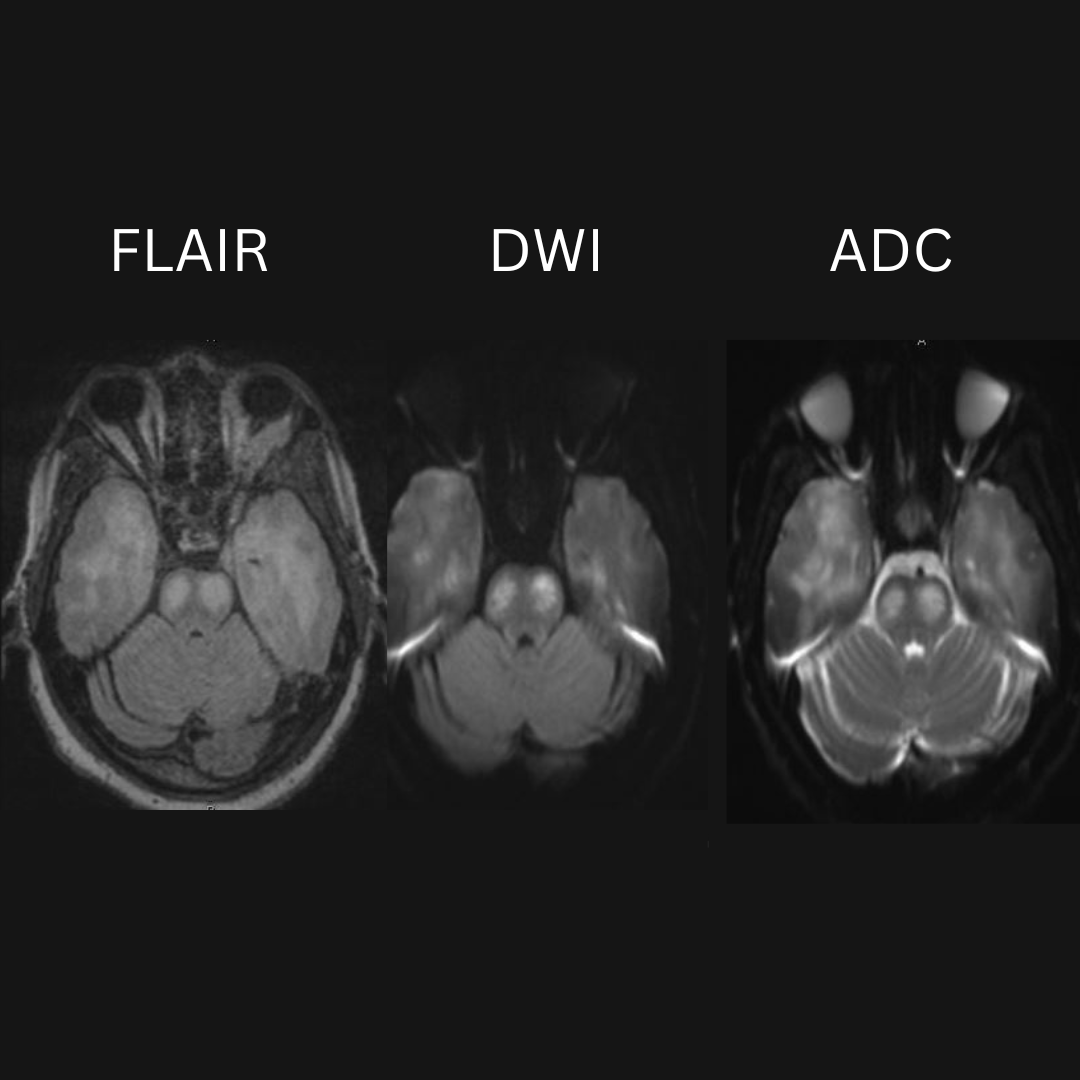 NeuroimagingN's tweet photo. Gliomatosis cerebri
·
Biopsy proven

#gliomatosiscerebri #neurooncology #neurology #neuroinflammation #neuroimaging #neurology #neuroradiology #oncology #neurosurgery #neurotwitter https://t.co/AYR26Fqxw4