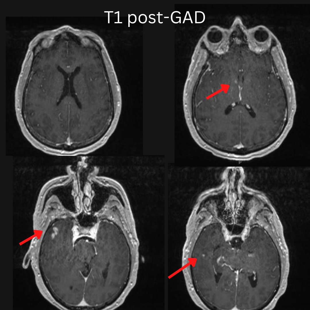NeuroimagingN's tweet photo. Gliomatosis cerebri
·
Biopsy proven

#gliomatosiscerebri #neurooncology #neurology #neuroinflammation #neuroimaging #neurology #neuroradiology #oncology #neurosurgery #neurotwitter https://t.co/AYR26Fqxw4