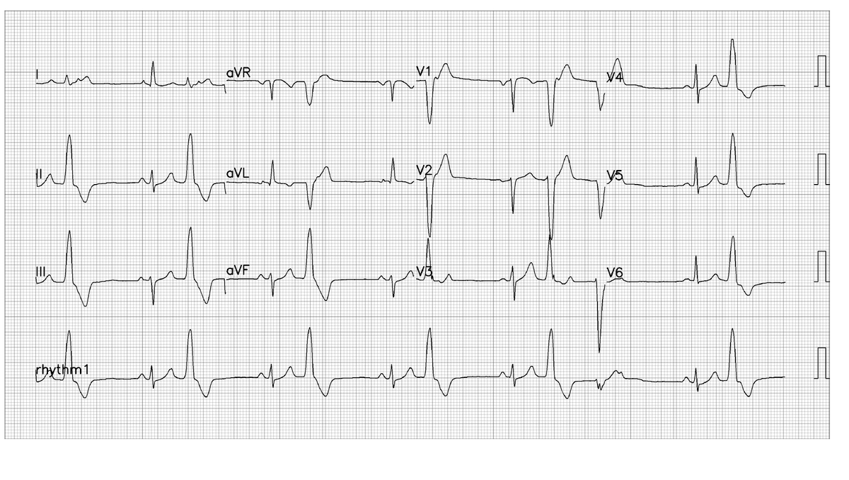 @ecgrhythms on Twitter: