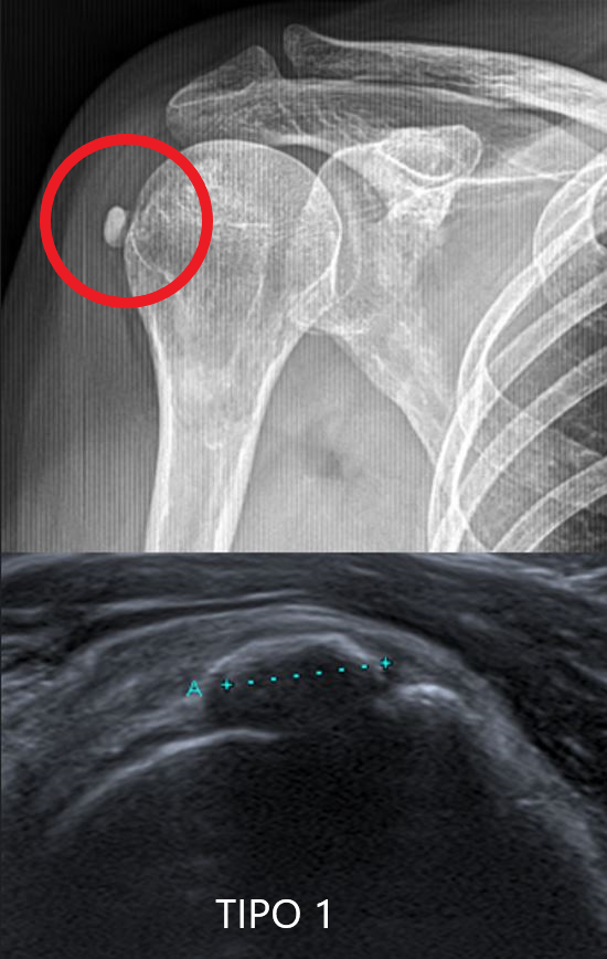 pepelermarx's tweet photo. Clasificación de tendinopatía calcificante (Gartner y Heyer) - de mayor a menor densidad:

Tipo 1: bien circunscrita y densa / sombra acústica que borra cortical humeral - idónea para técnica de punción-lavado 

#IDOR_2022 #InternationalDayofRadiology
@SermeMsk @residentesSERAM https://t.co/vkKyEbg0Bh