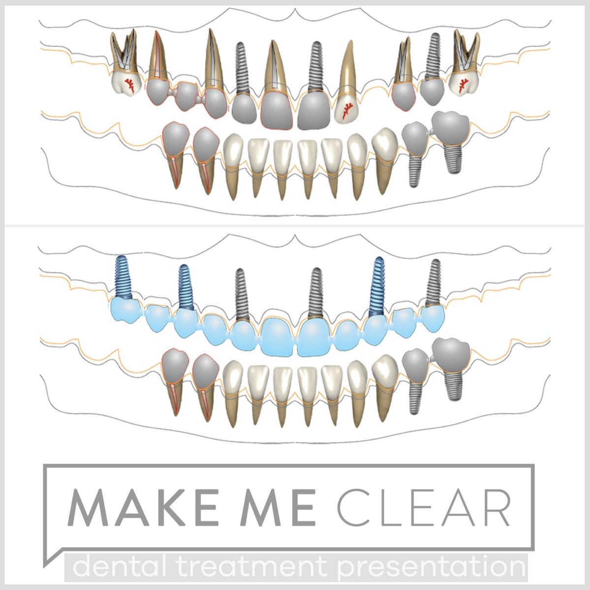 makemeclearapp's tweet photo. https://t.co/ItZvk564WH

•
•
•
•
•

#treatmentplanning #dentistry #dentalsoftware #treatmentplanpresentation #planpresentation #communicationindentistry #interdisciplinarydentistry
#dentalmarketing https://t.co/SeI4uaaVJq